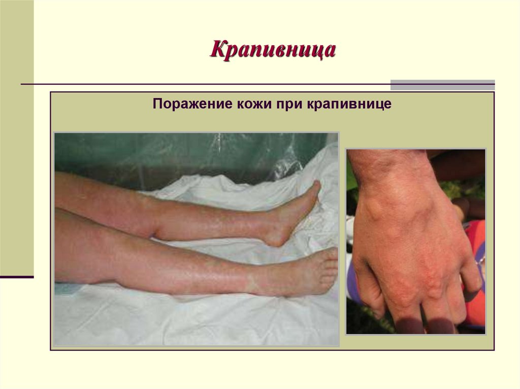 Крапивница