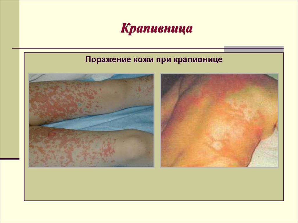 Крапивница