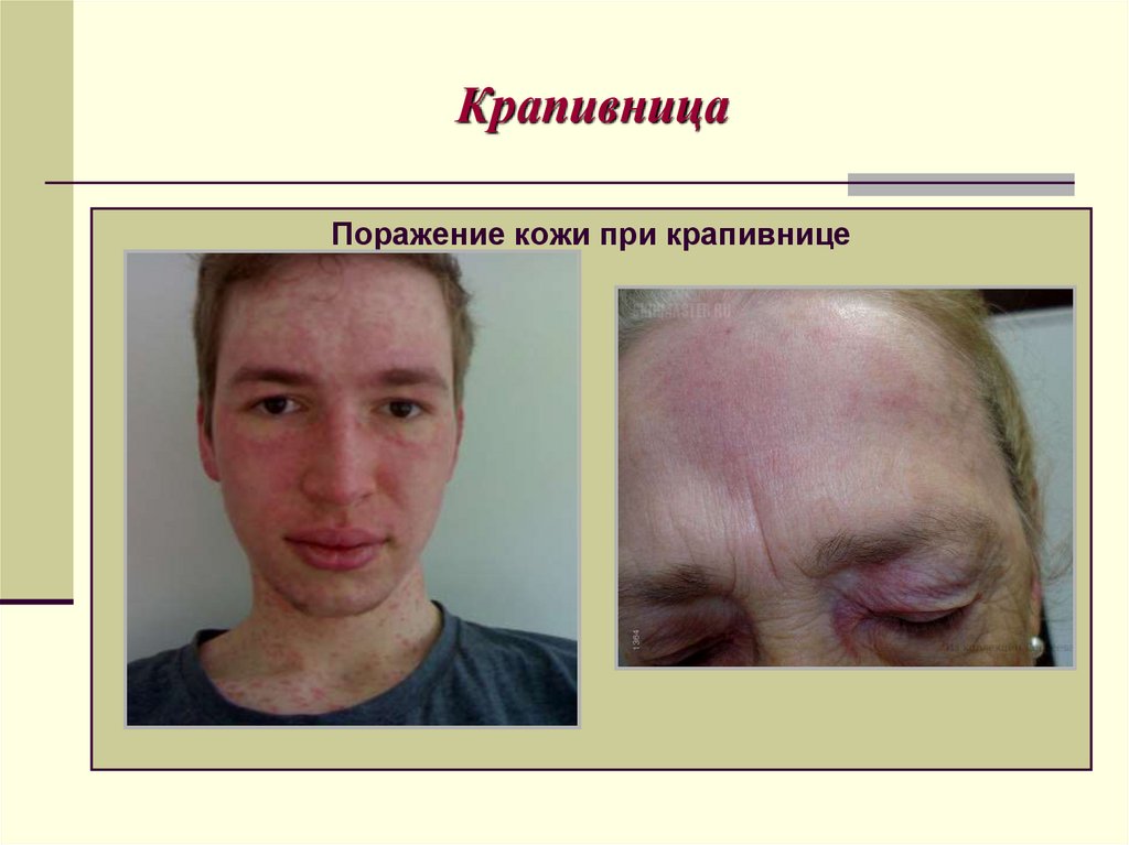 Крапивница