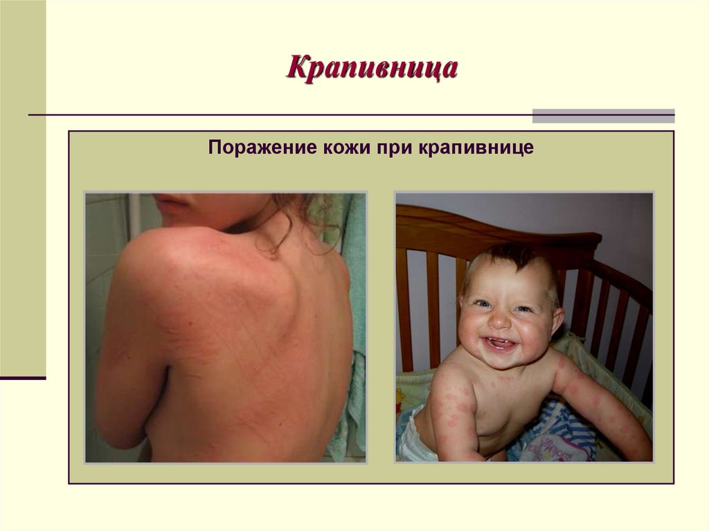 Крапивница