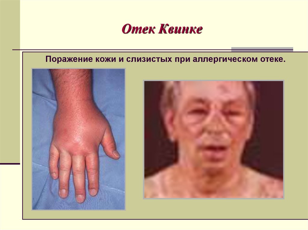 Отек Квинке