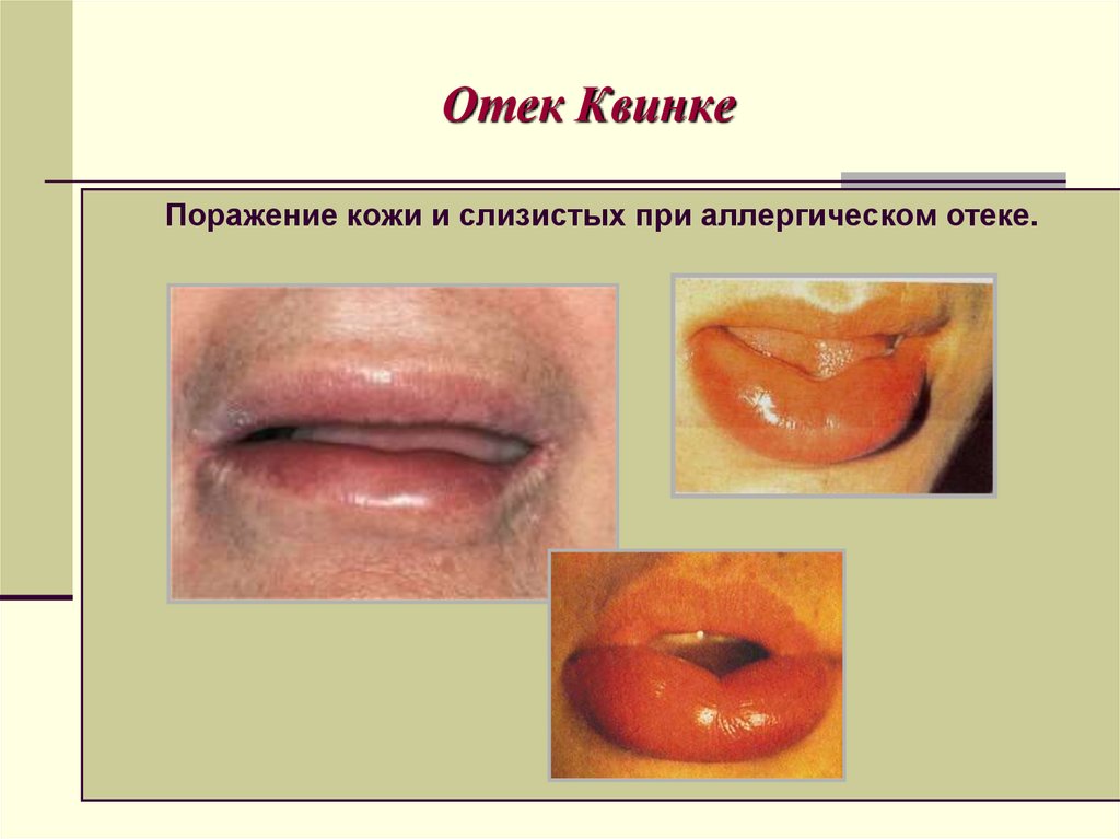 Отек Квинке