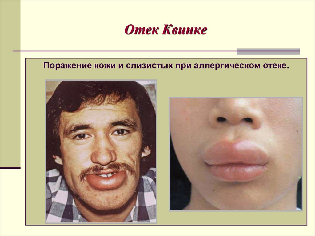 Отек Квинке