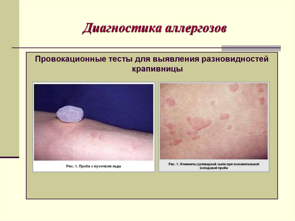 Диагностика аллергозов