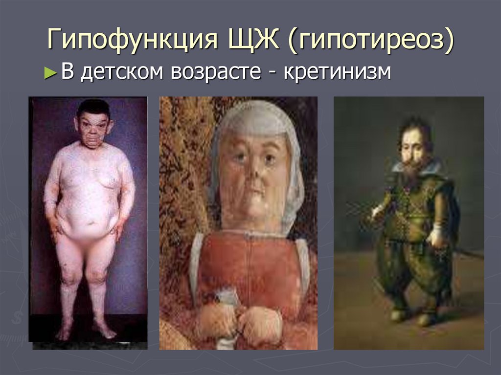 Гипофункция ЩЖ (гипотиреоз)