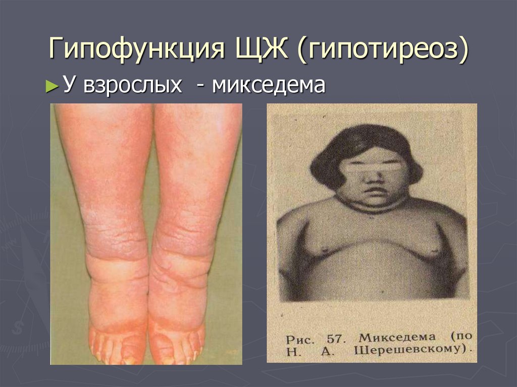Гипофункция ЩЖ (гипотиреоз)
