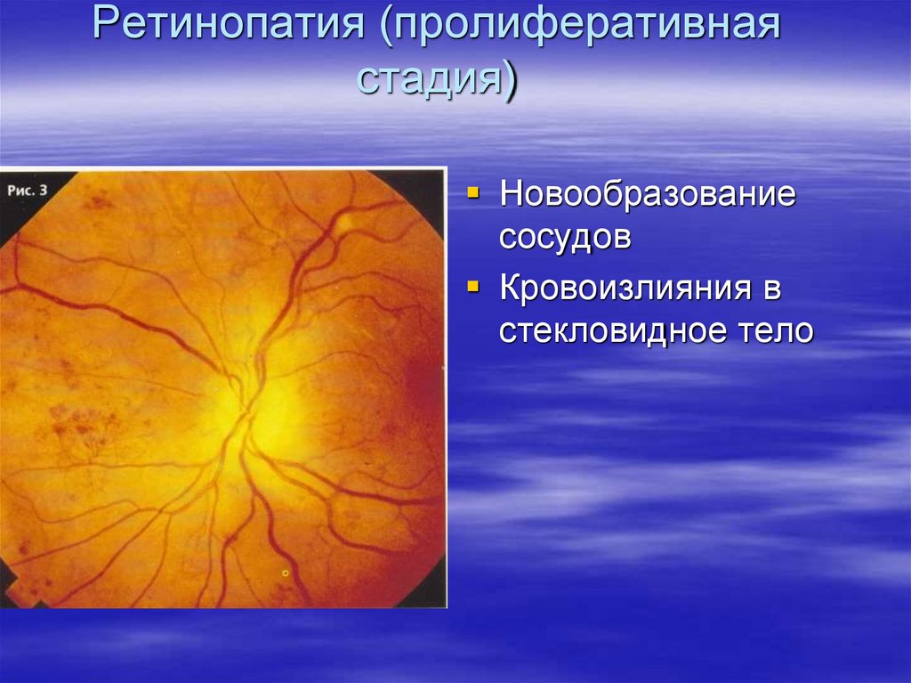 Ретинопатия (пролиферативная стадия)