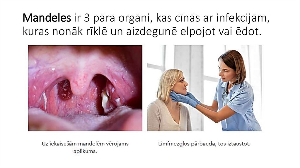 Mandeles ir 3 pāra orgāni, kas cīnās ar infekcijām, kuras nonāk rīklē un aizdegunē elpojot vai ēdot.