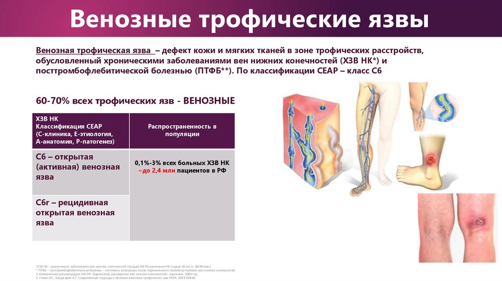 Венозные трофические язвы