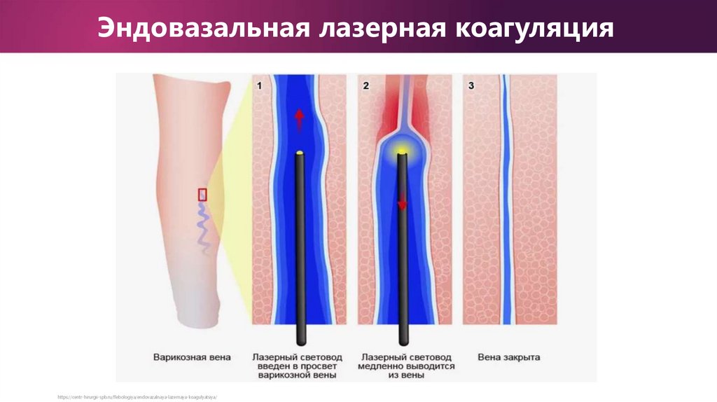 Эндовазальная лазерная коагуляция