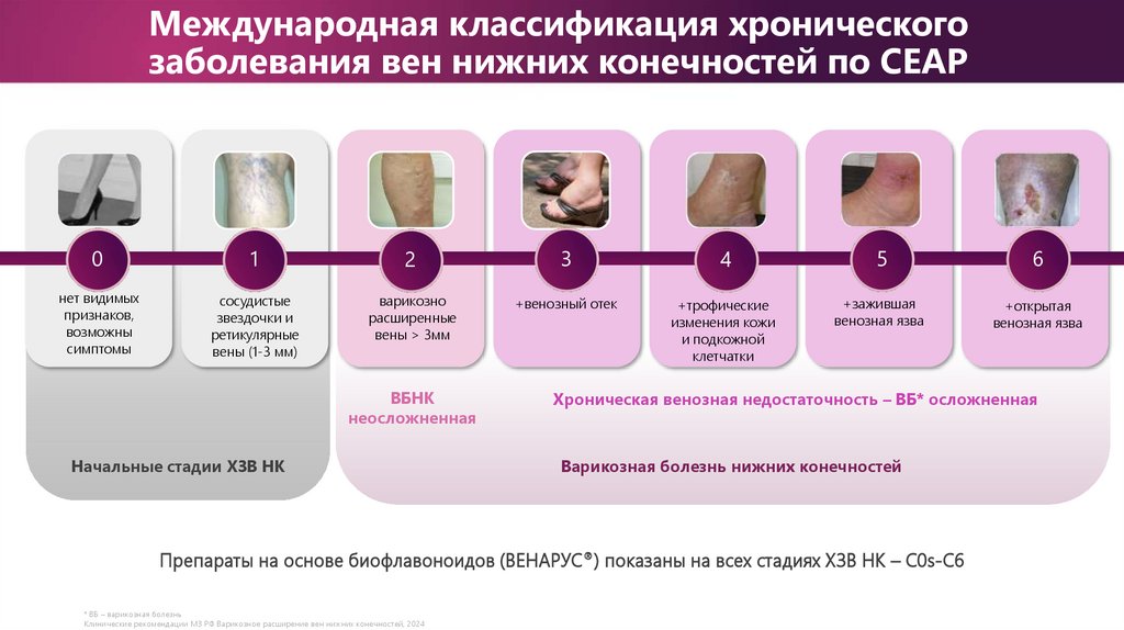 Международная классификация хронического заболевания вен нижних конечностей по CEAP