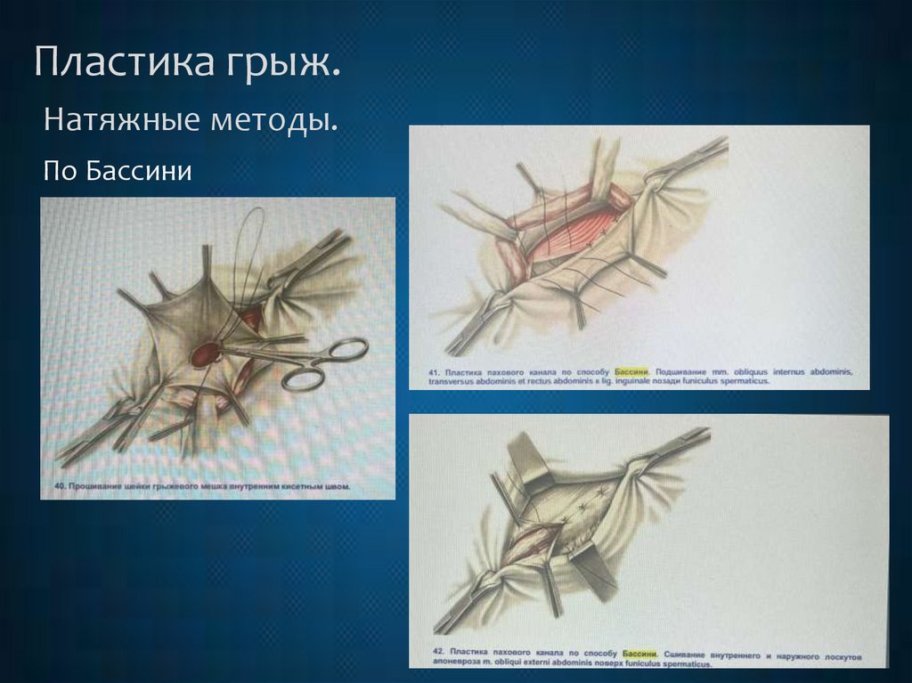 Пластика грыж. Натяжные методы.