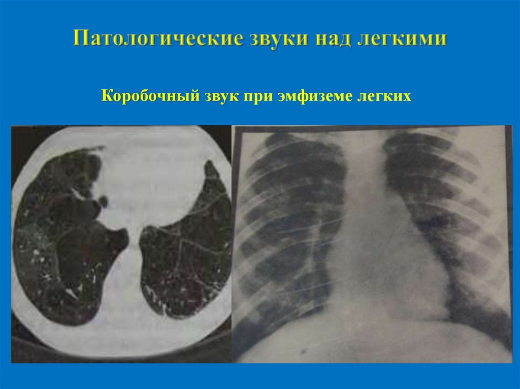 Патологические звуки над легкими