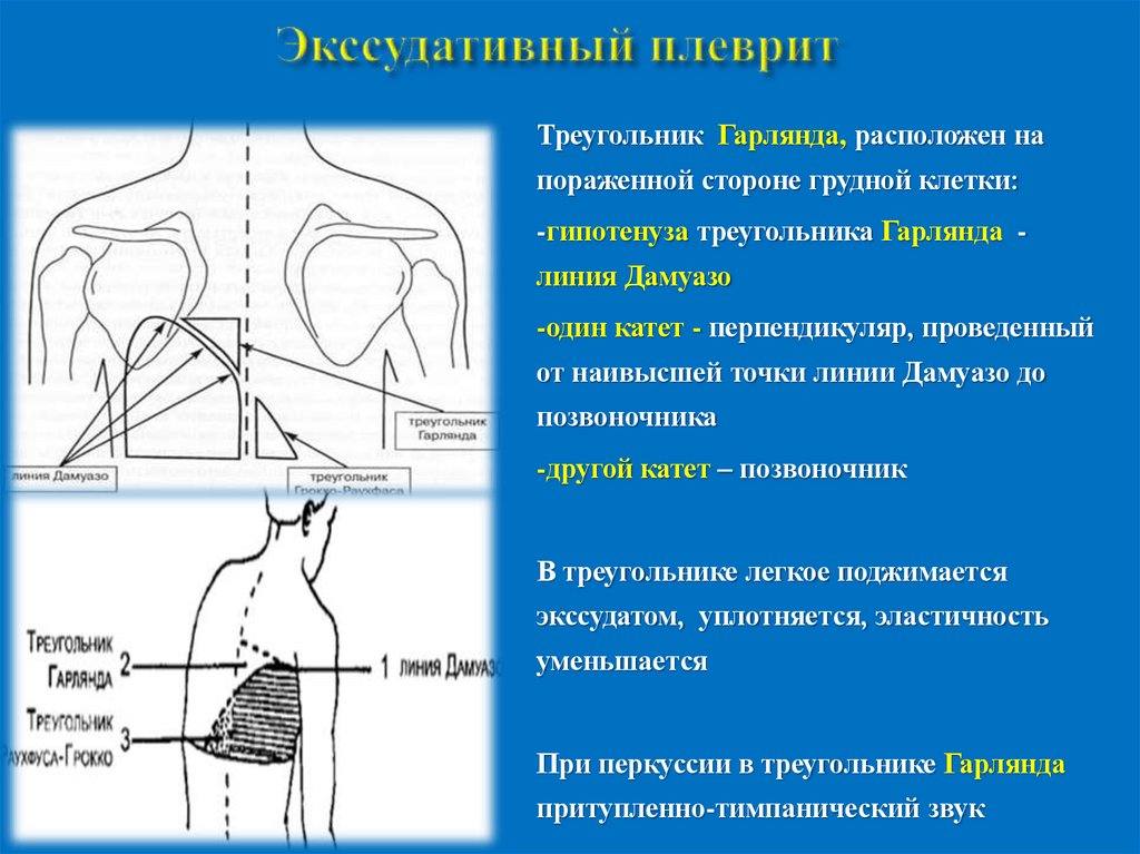Экссудативный плеврит