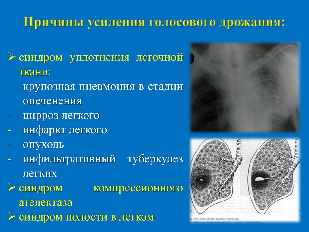 Причины усиления голосового дрожания: