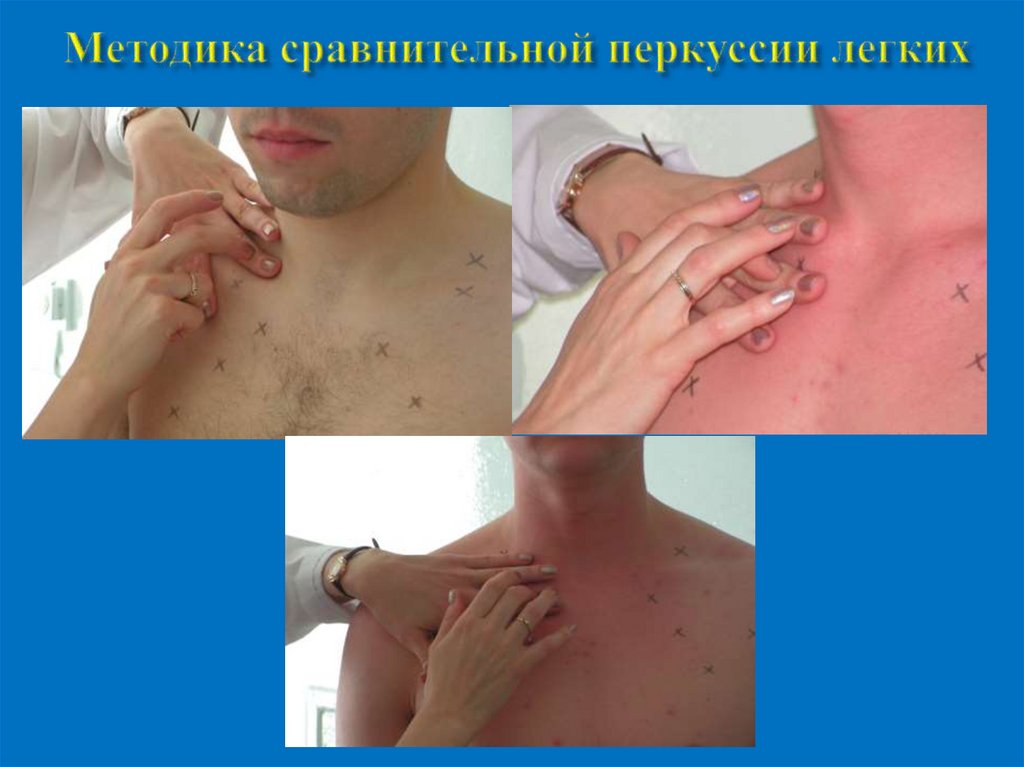 Методика сравнительной перкуссии легких