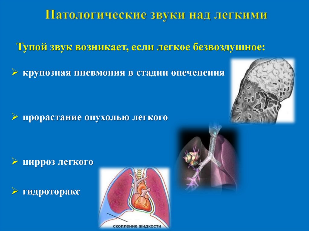 Патологические звуки над легкими
