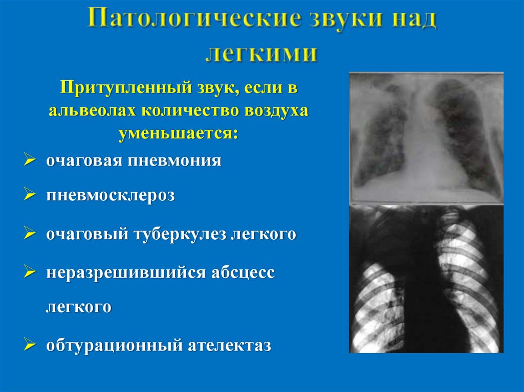 Патологические звуки над легкими
