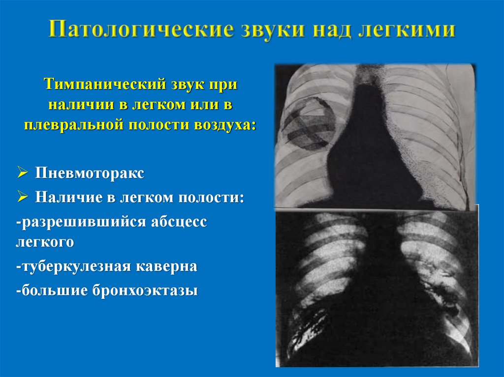 Патологические звуки над легкими