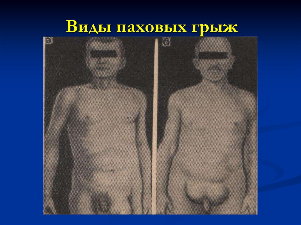 Виды паховых грыж