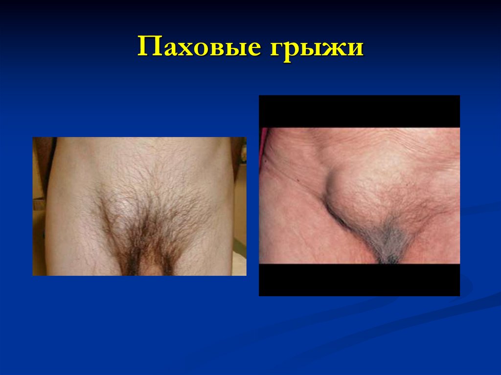 Паховые грыжи