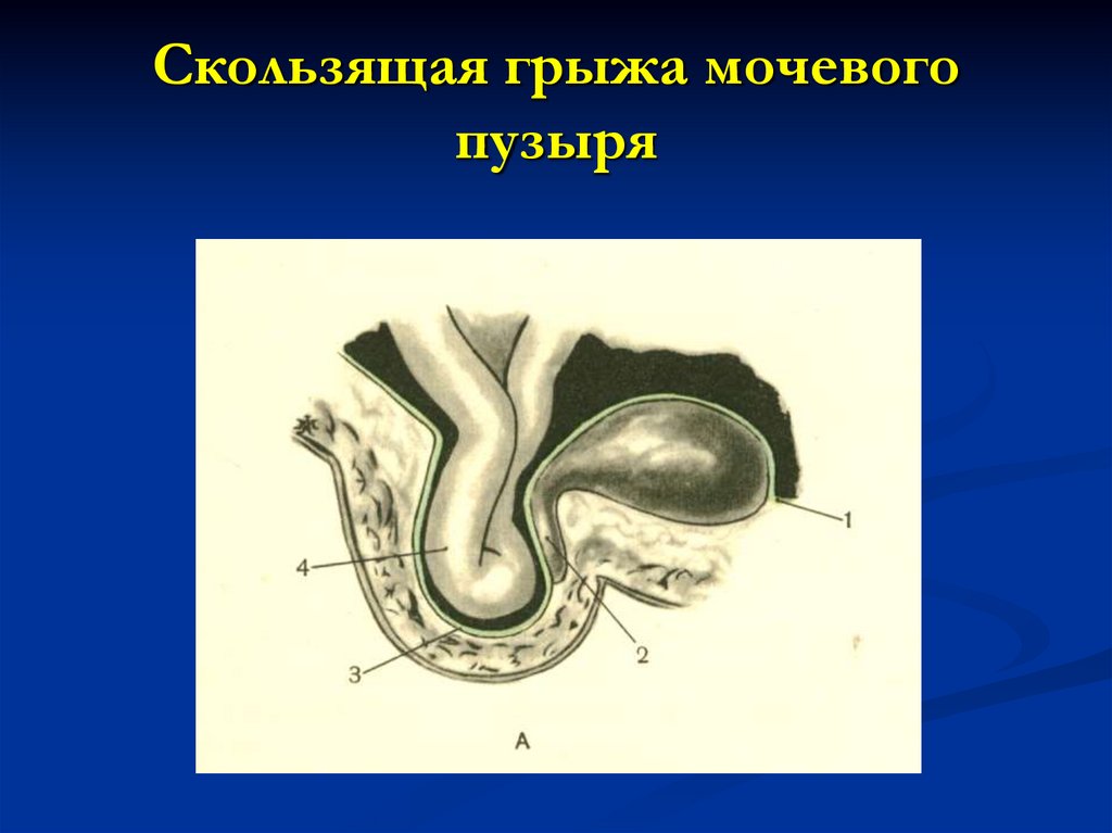Скользящая грыжа мочевого пузыря