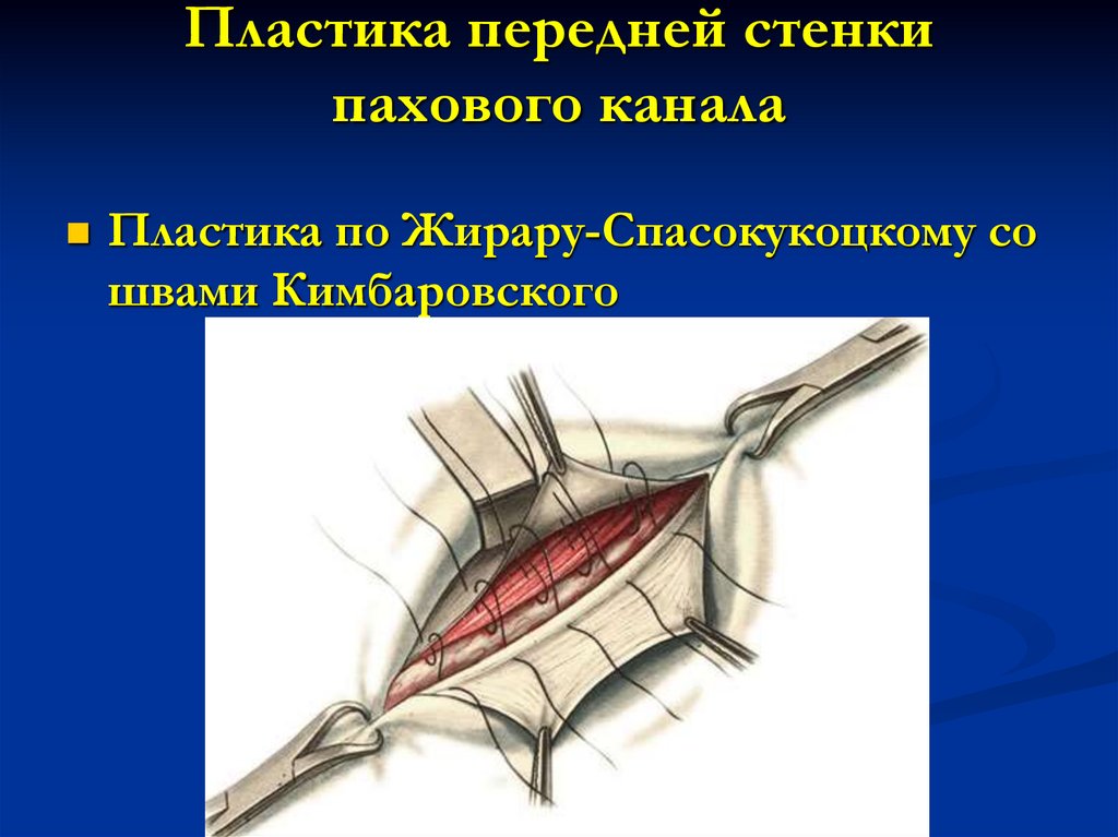 Пластика передней стенки пахового канала
