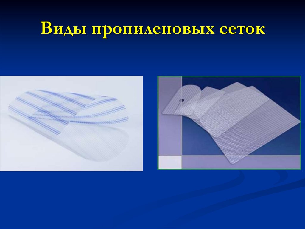 Виды пропиленовых сеток