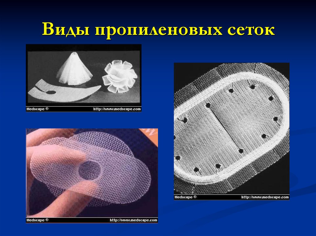 Виды пропиленовых сеток