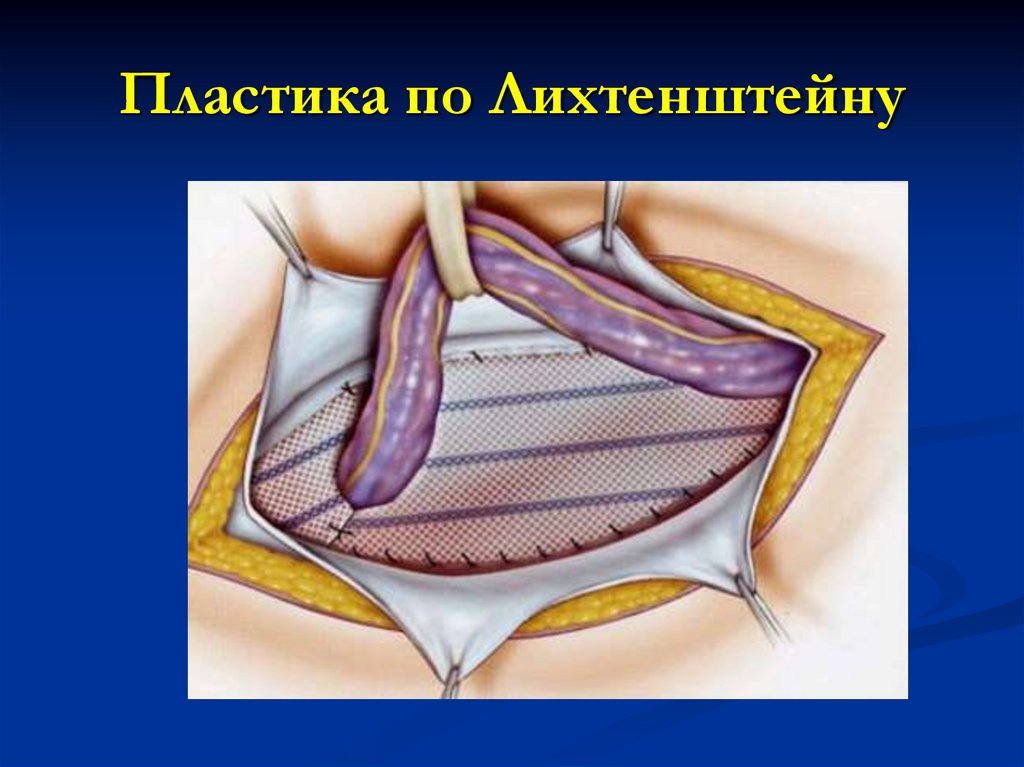 Пластика по Лихтенштейну