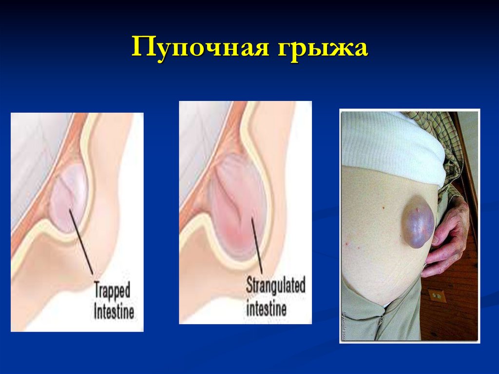 Пупочная грыжа