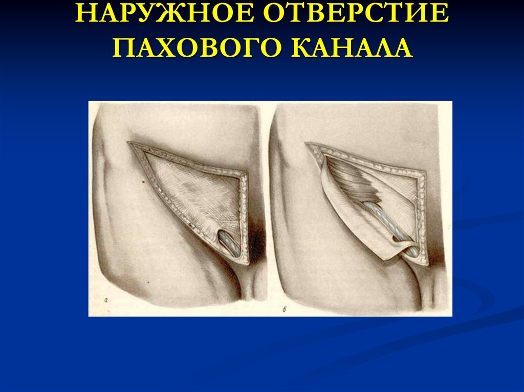 НАРУЖНОЕ ОТВЕРСТИЕ ПАХОВОГО КАНАЛА