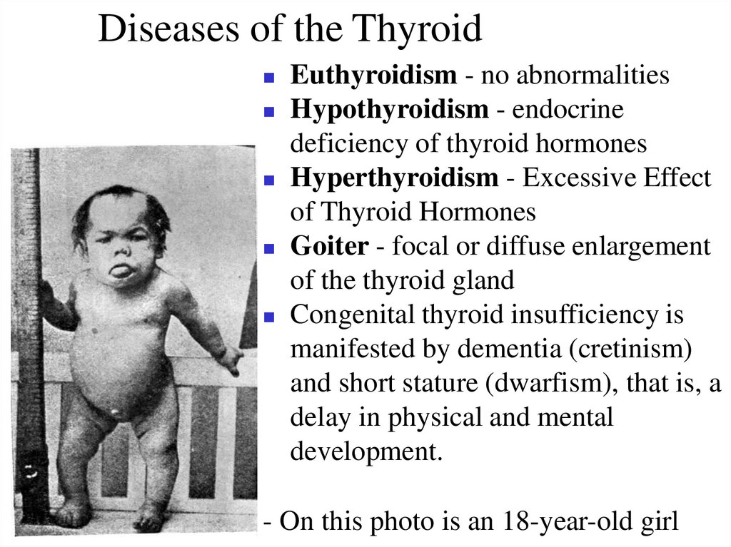 Diseases of the Thyroid