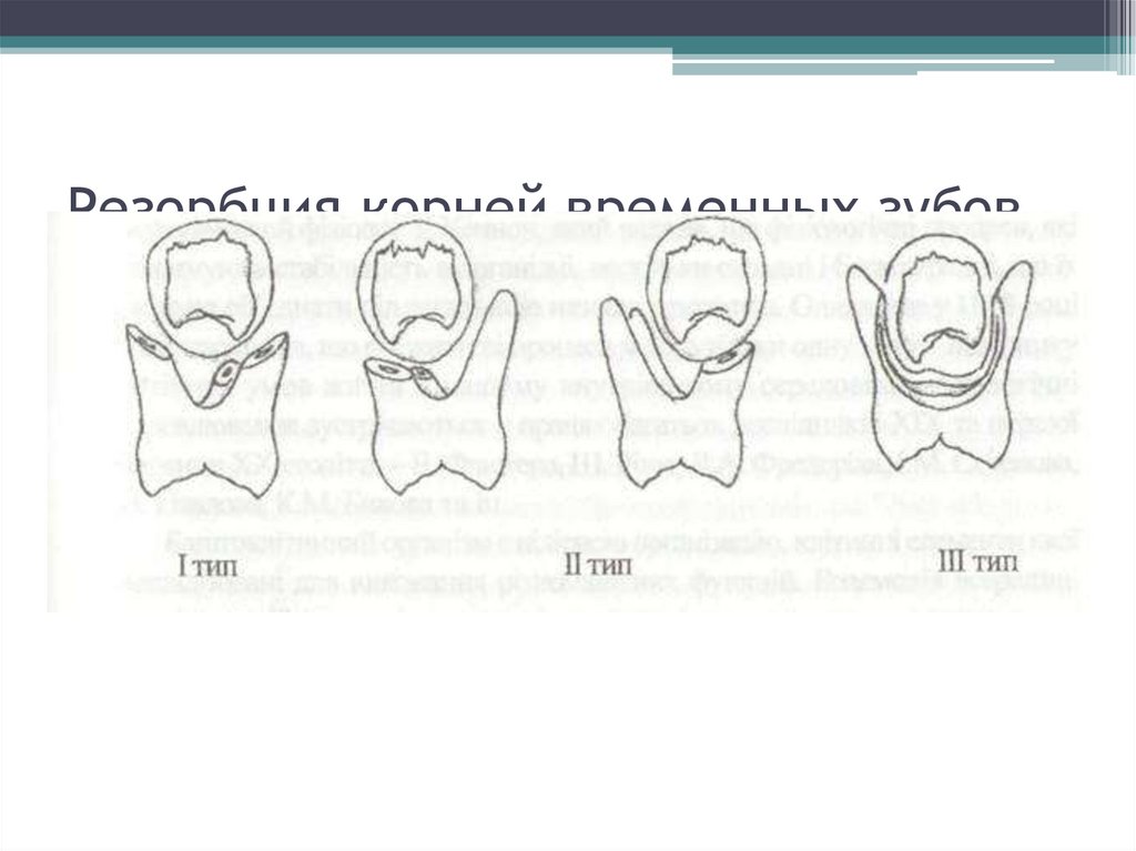 Резорбция корней временных зубов