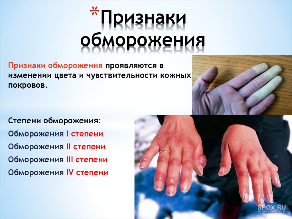 Признаки обморожения