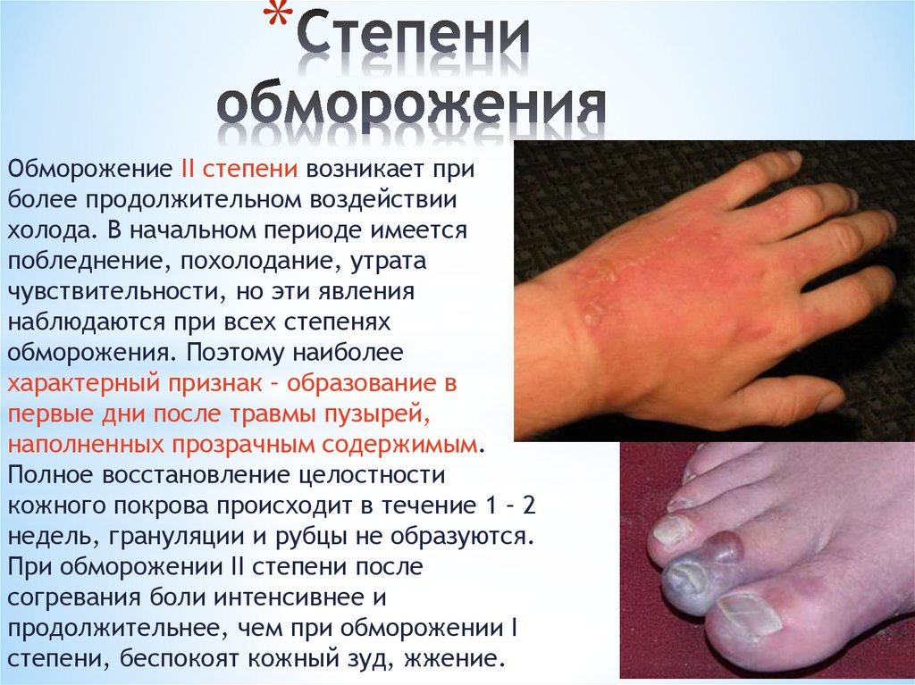 Степени обморожения