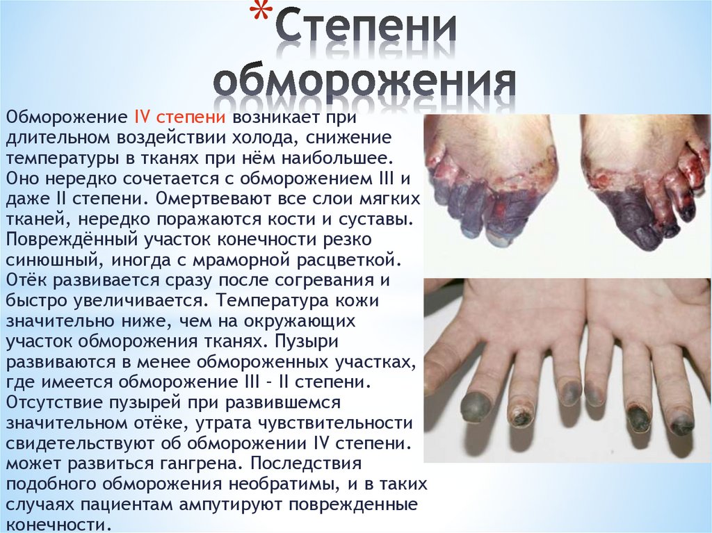 Степени обморожения