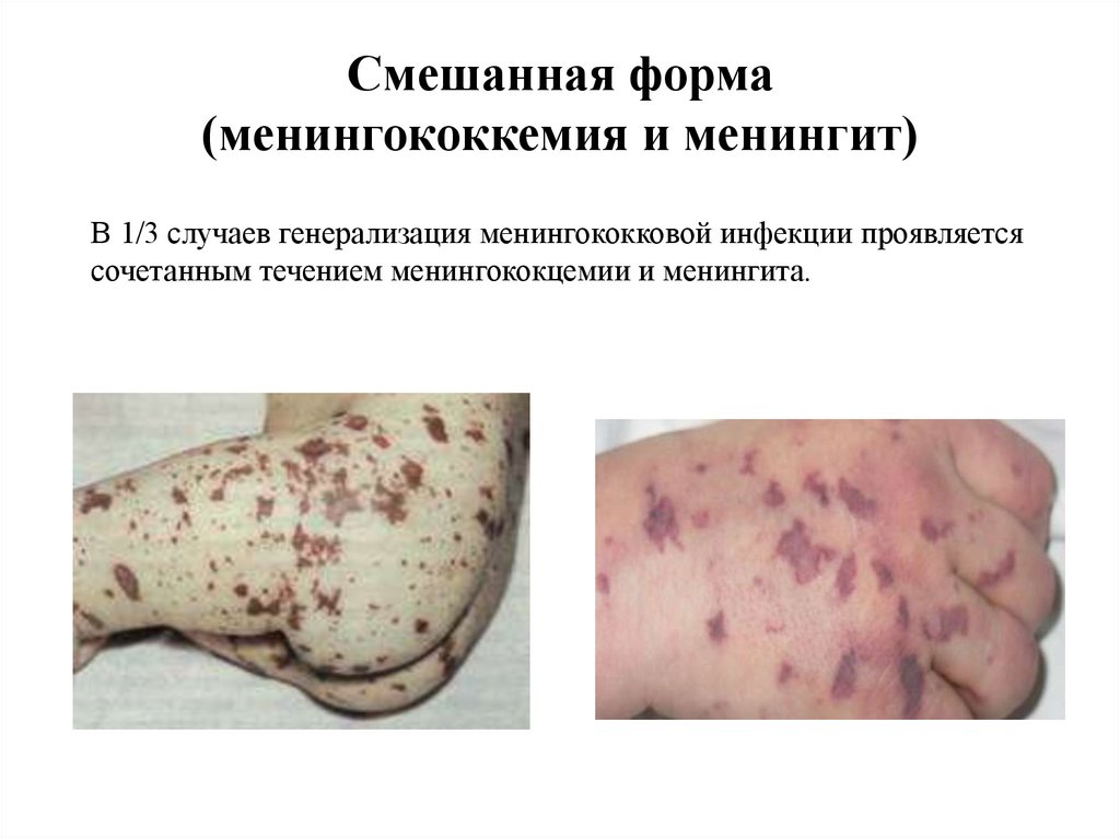 Смешанная форма (менингококкемия и менингит)