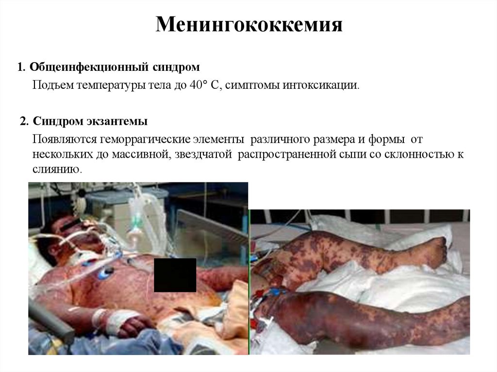 Менингококкемия