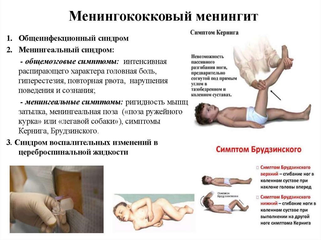 Менингококковый менингит