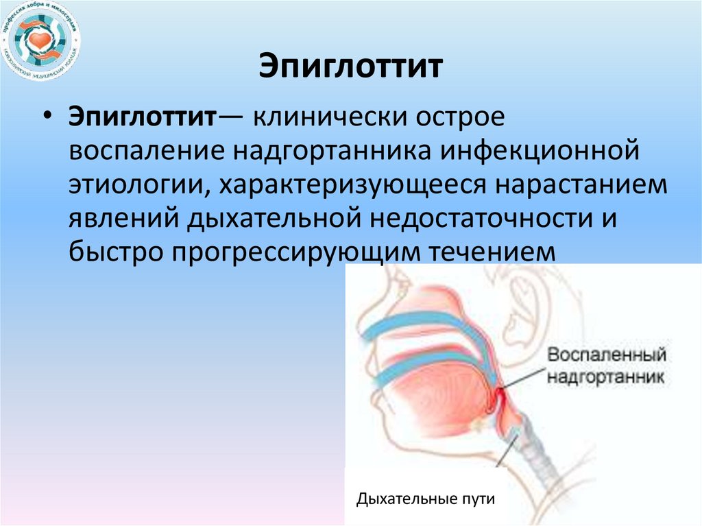 Эпиглоттит