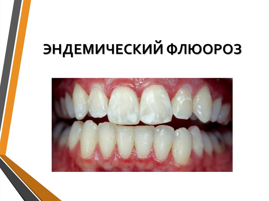 ЭНДЕМИЧЕСКИЙ ФЛЮОРОЗ