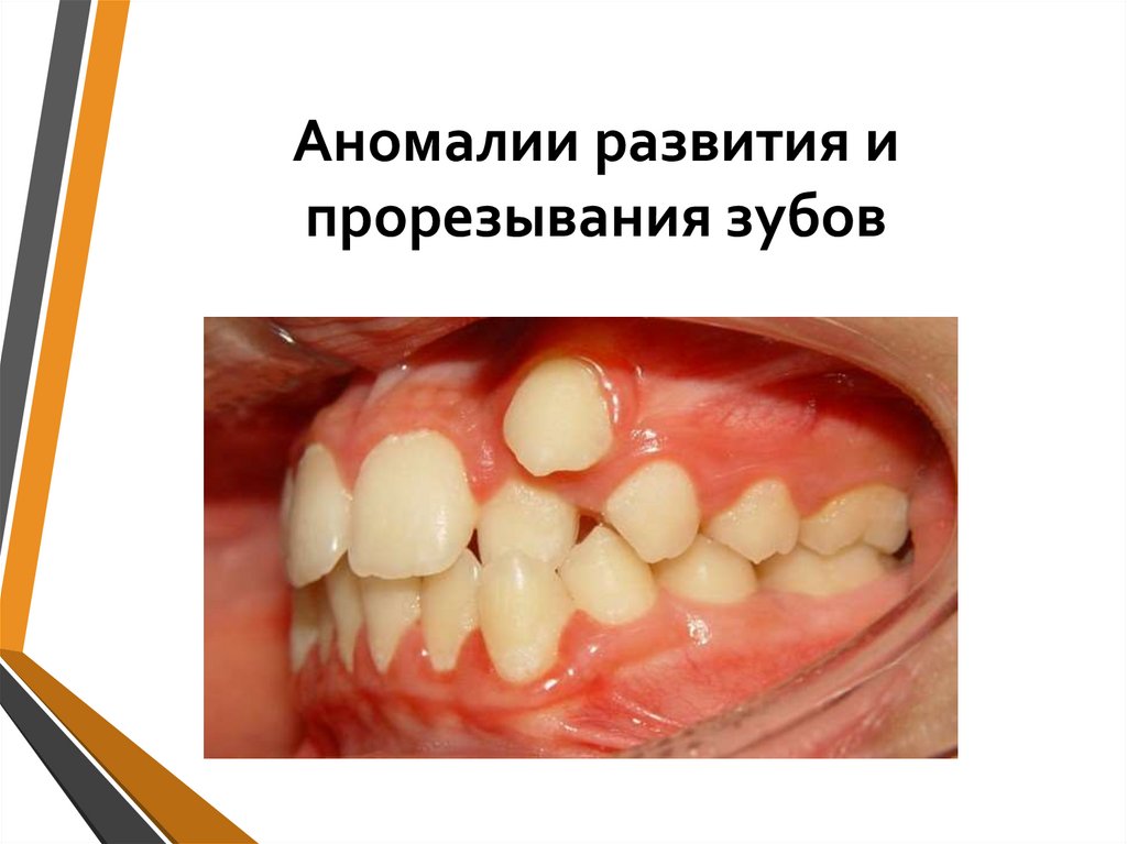 Аномалии развития и прорезывания зубов
