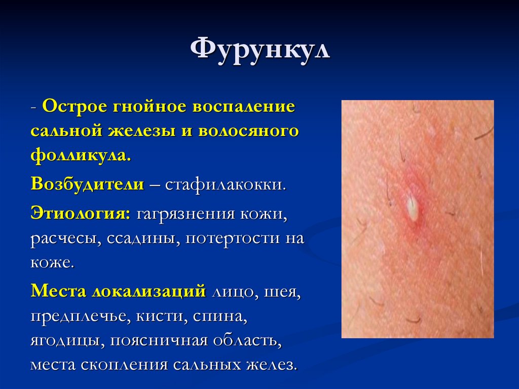 Фурункул