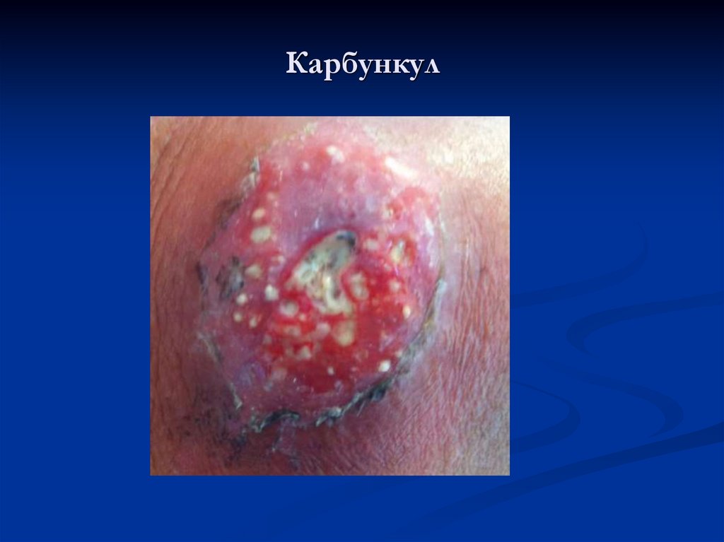 Карбункул