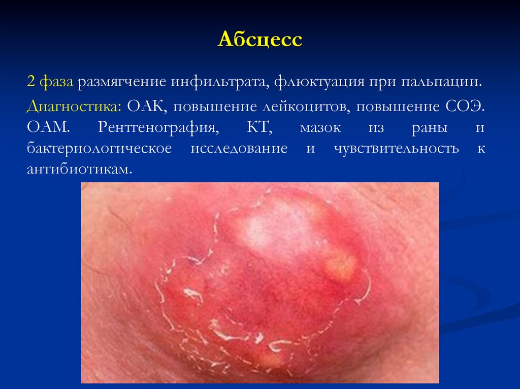 Абсцесс
