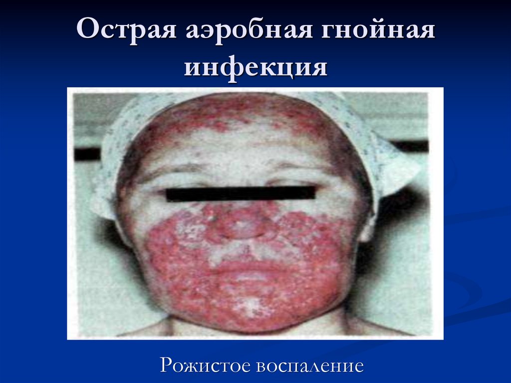 Острая аэробная гнойная инфекция
