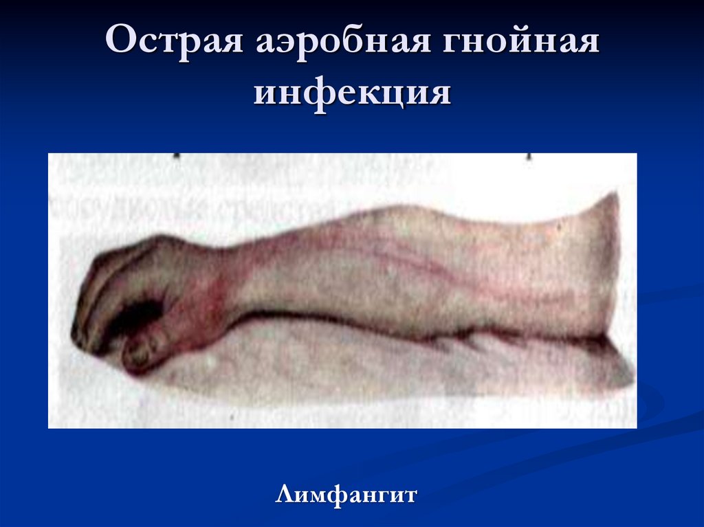 Острая аэробная гнойная инфекция