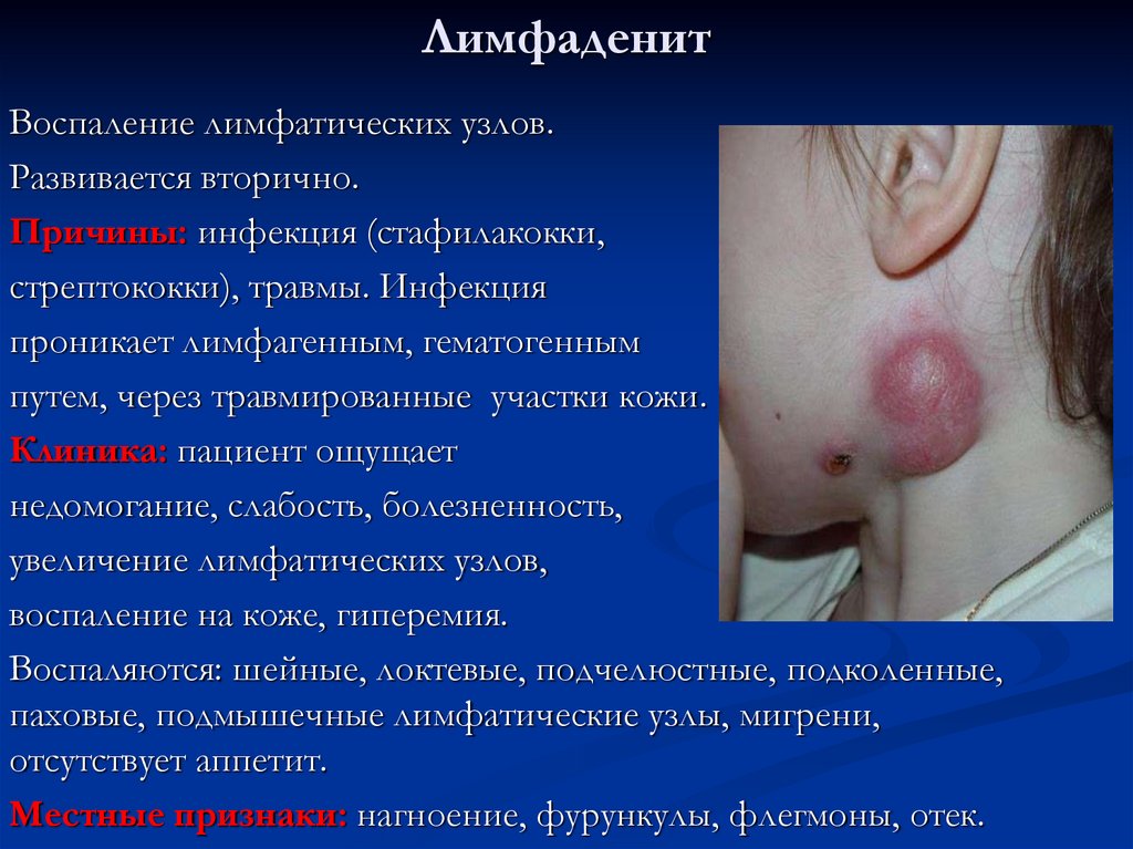 Лимфаденит