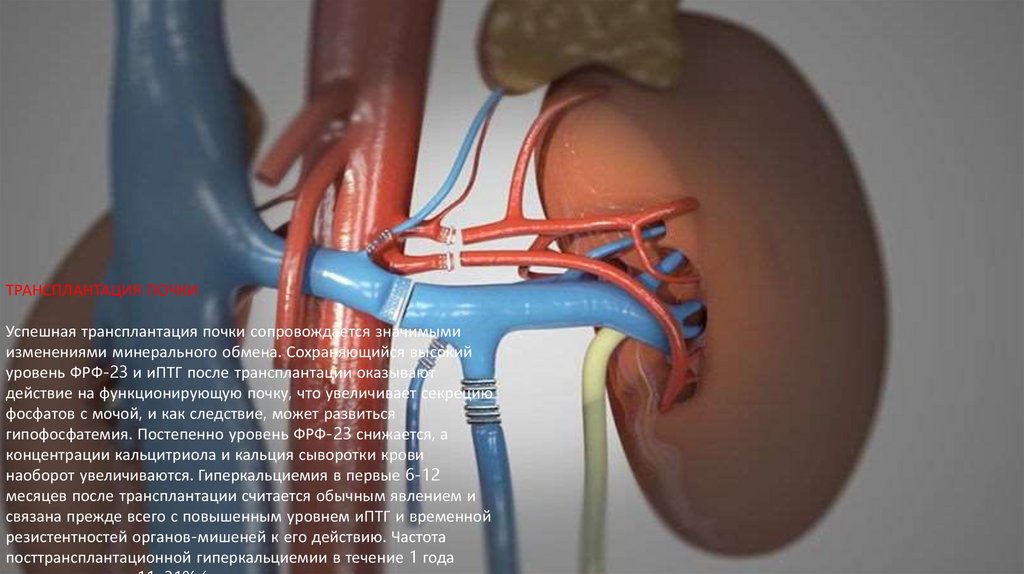 ТРАНСПЛАНТАЦИЯ ПОЧКИ Успешная трансплантация почки сопровождается значимыми изменениями минерального обмена. Сохраняющийся